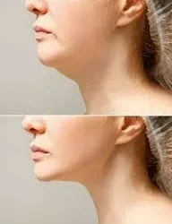 Eliminación de papada: Vuelva a amar tu perfil